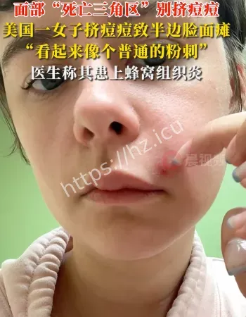 女子挤痘致瘫